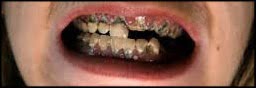 Bad Teeth Human